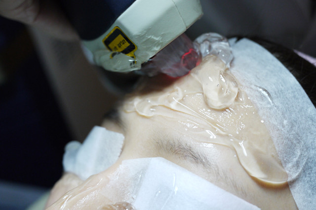 光纖粉餅雷射改善額頭膚質治療