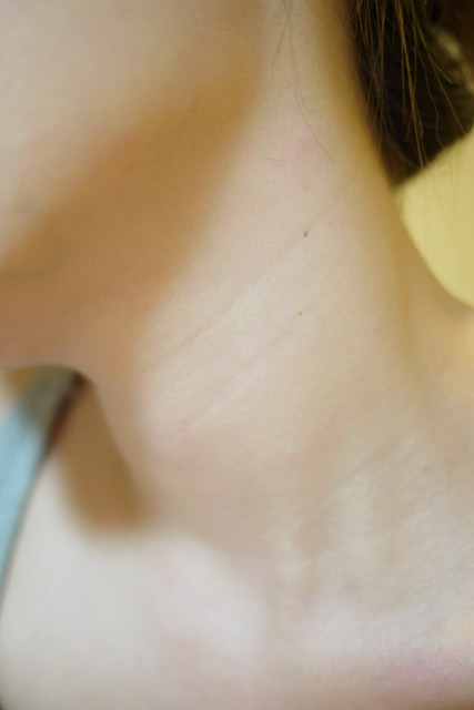 光纖粉餅雷射可以治療脖子部位