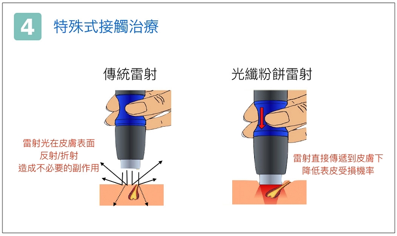光纖粉餅雷射特殊式接觸治療