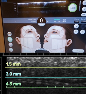 Ulthera極線音波醫師隨時調整治療參數2