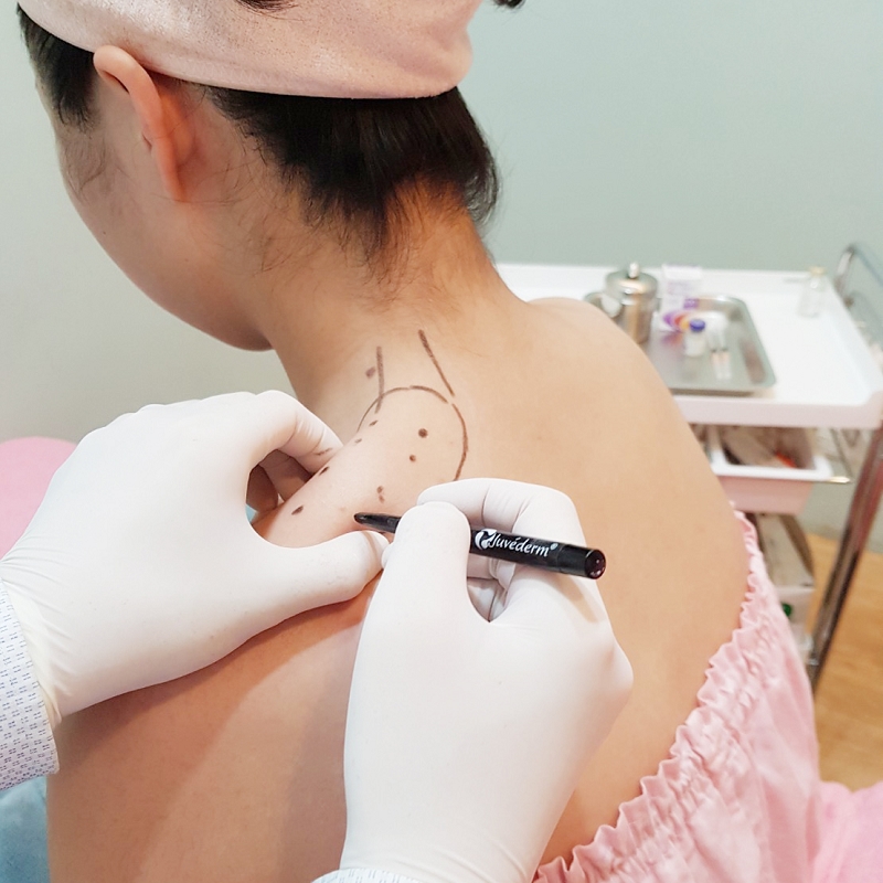 瘦肩治療精準標記注射點