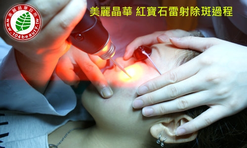 紅寶石雷射治療除斑過程