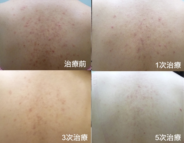 德國光纖粉餅雷射 亮白 毛孔 痘疤 美麗晶華診所