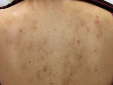 德國光纖粉餅雷射 亮白 毛孔 痘疤 美麗晶華診所