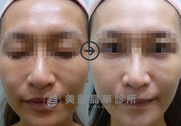 德國光纖粉餅雷射改善全臉膚色不均暗沉黑肉底膚質