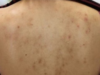 德國光纖粉餅雷射治療背部色素痘疤