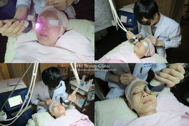 光纖粉餅雷射黑眼圈治療過程