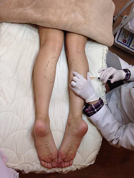 肉毒桿菌瘦小腿治療過程