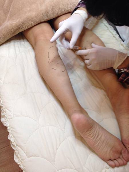 肉毒桿菌瘦小腿治療過程