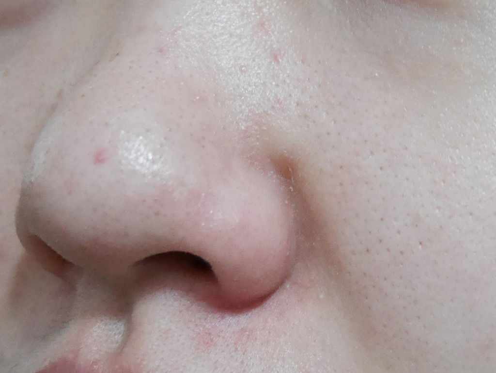 水涵氧&保濕導入術前鼻頭粉刺近照