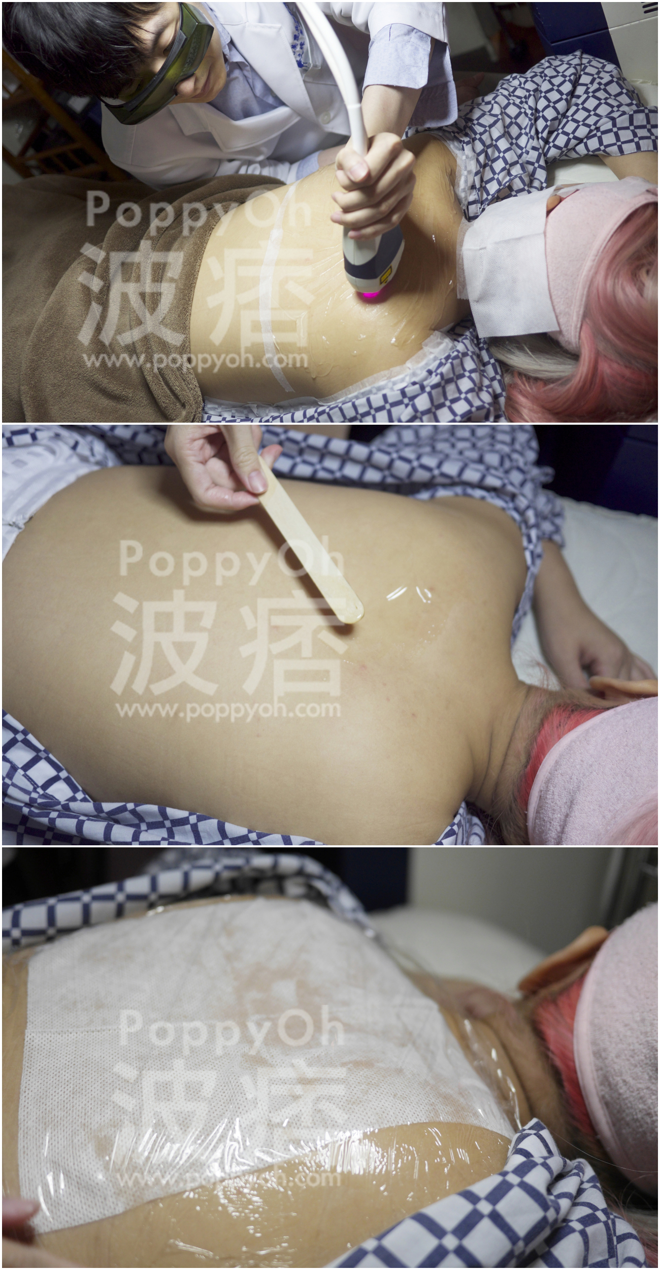 光纖粉餅雷射背部治療過程
