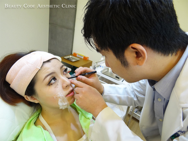 陳志龍醫師玻尿酸淚溝治療前標記注射位置
