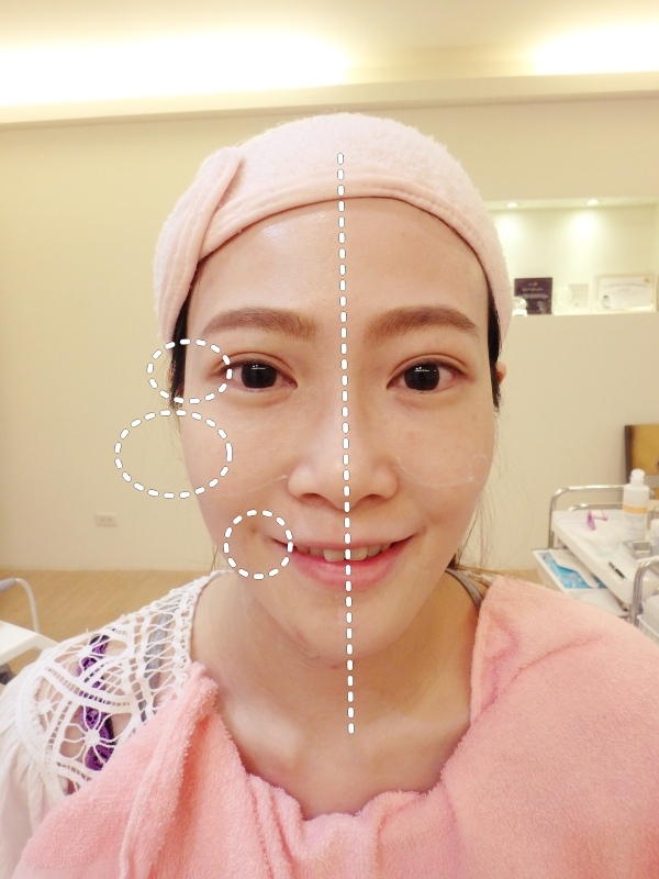 極線音波拉皮右臉治療後立即拉提效果