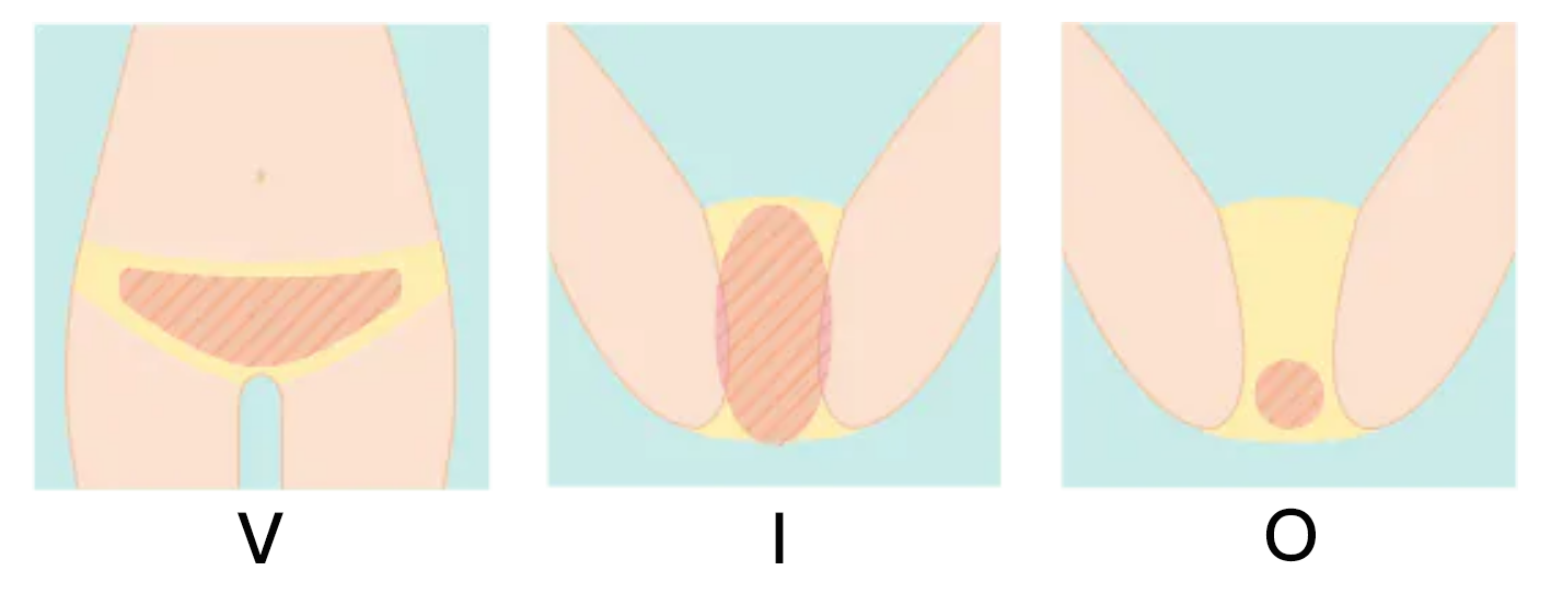 VIO又名巴西全除，就是依照私密處周邊毛髮的生長位置進行的簡單描述，如上圖所示。（由左至右：Ｖ、Ｉ、Ｏ）