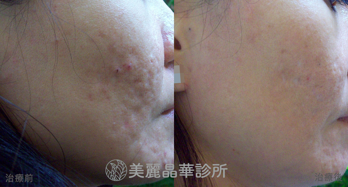痘疤凹洞 使用皮下剝離 美麗晶華治療範例分享6